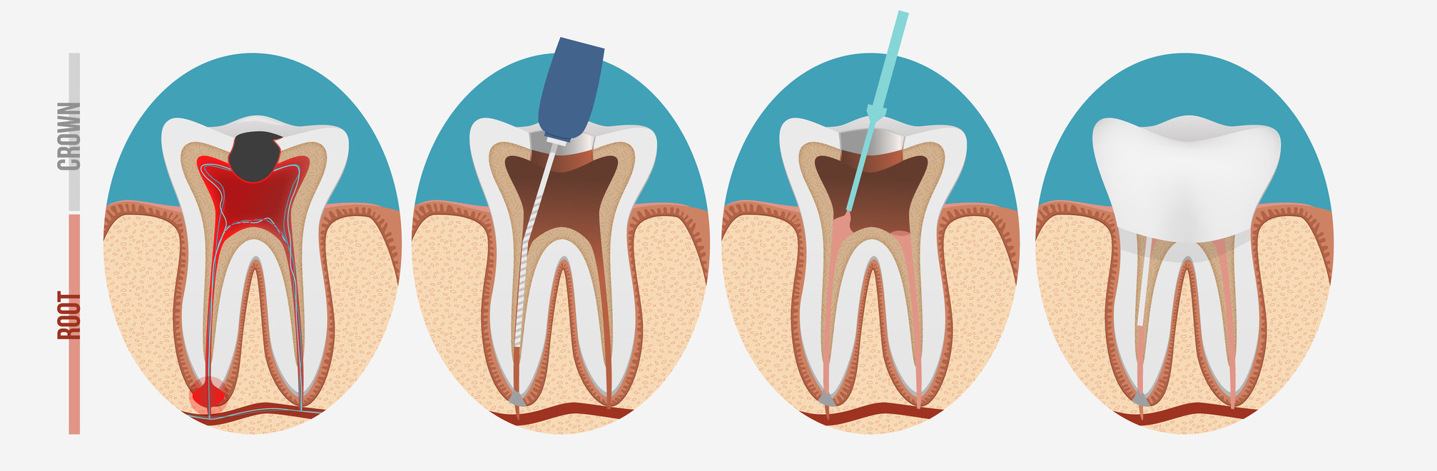 Root canal process