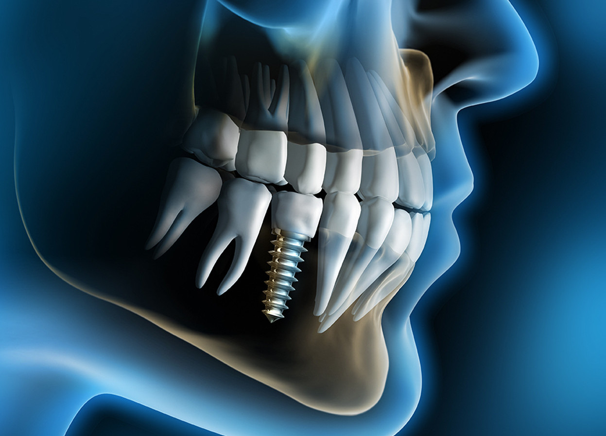 Dental-Implants-2